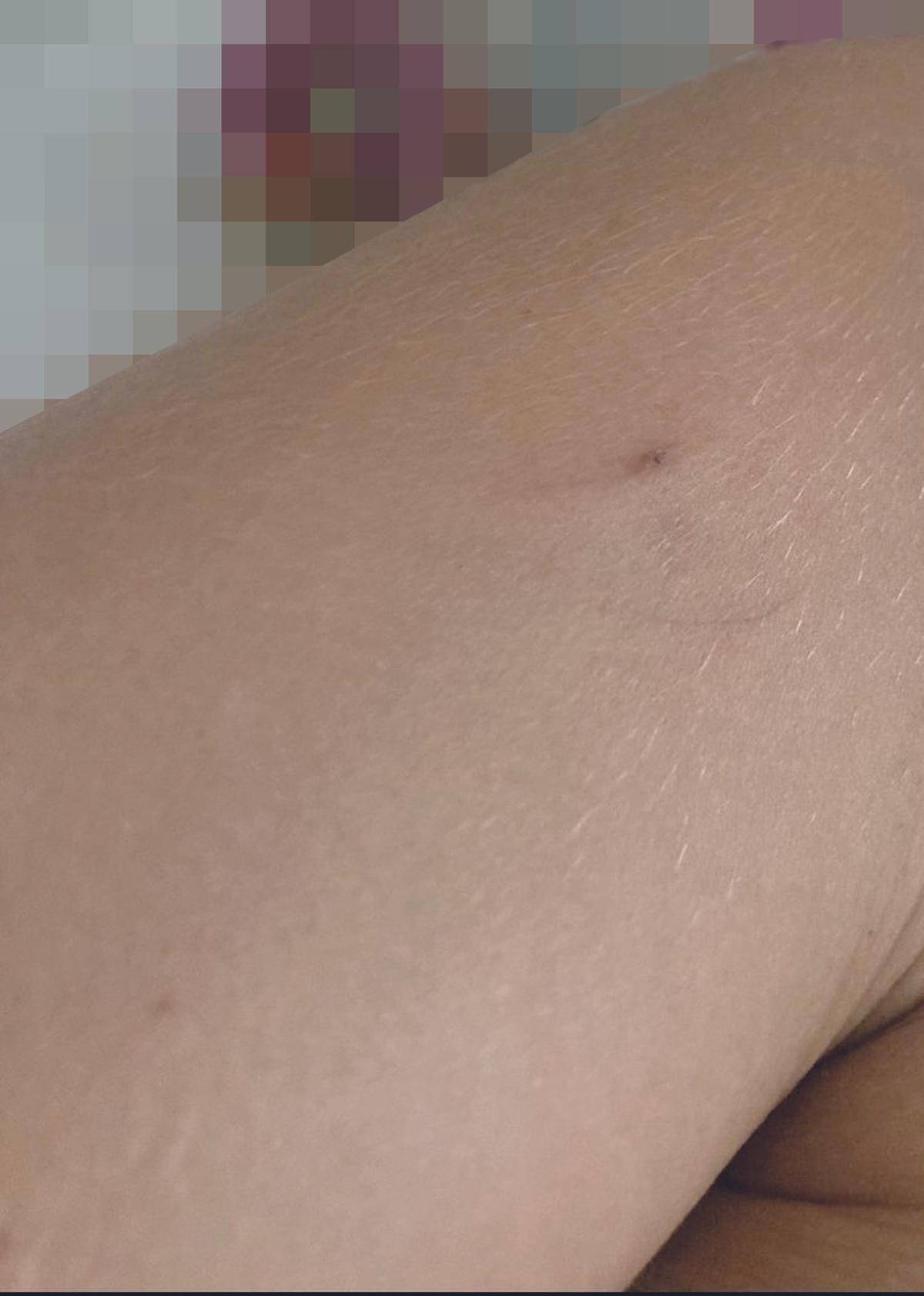 Marca de un pinchazo en el brazo de una joven que ha denunciado un agresión de este tipo.