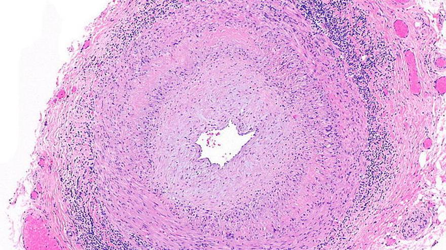 Micrografía de arteritis de células gigantes