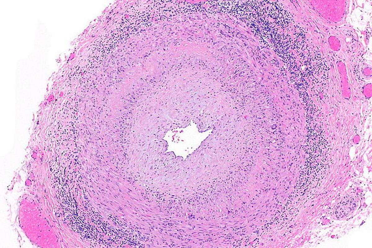 Micrografía de arteritis de células gigantes