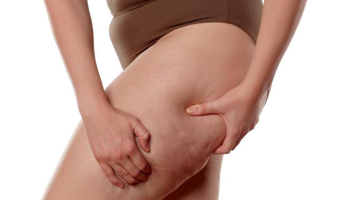 Contra la celulitis  ¿Odias la celulitis? Ni te imaginas lo fácil que es  combatirla siguiendo estas pautas