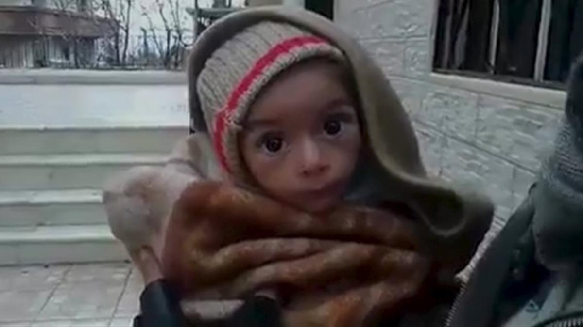 Un bebé desnutrido en Madaya.