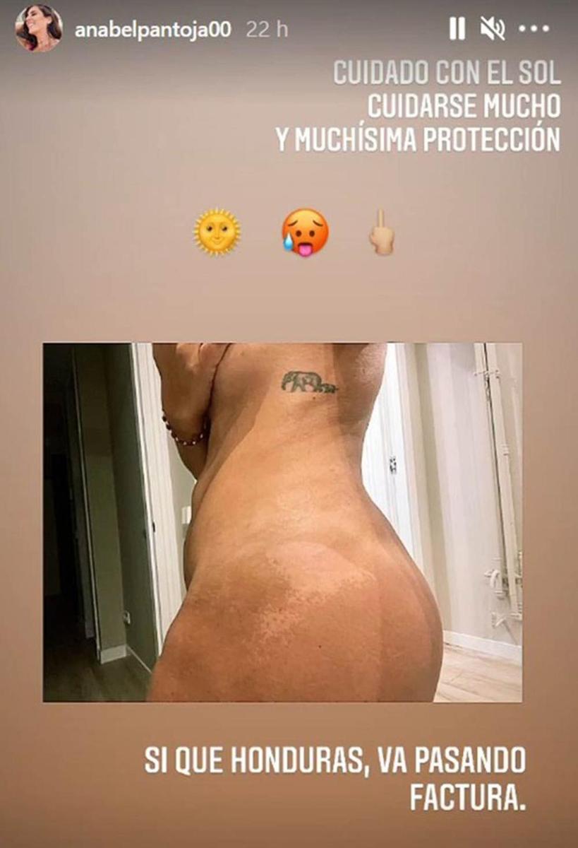 Quemaduras de Anabel Pantoja