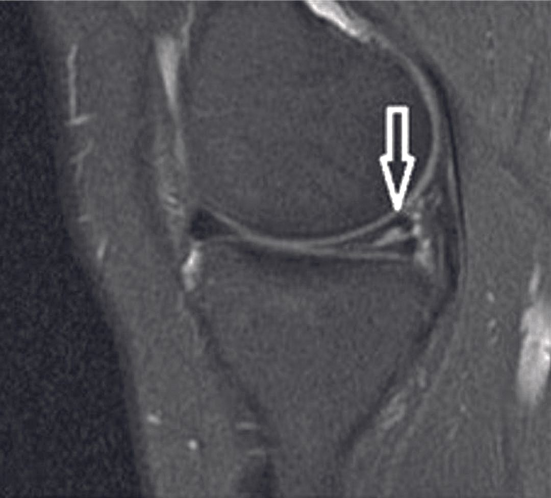 RMN: Rotura del menisco interno de la rodilla.