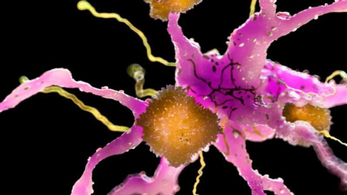 Los grupos de alguna proteínas obstruyen las células cerebrales en la enfermedad de Alzheimer.