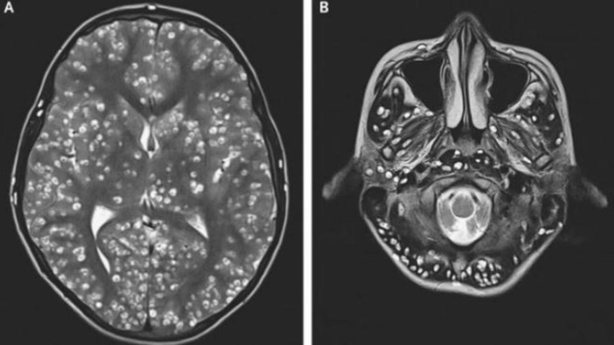 Un joven muere por la presencia de una plaga de gusanos en el cerebro