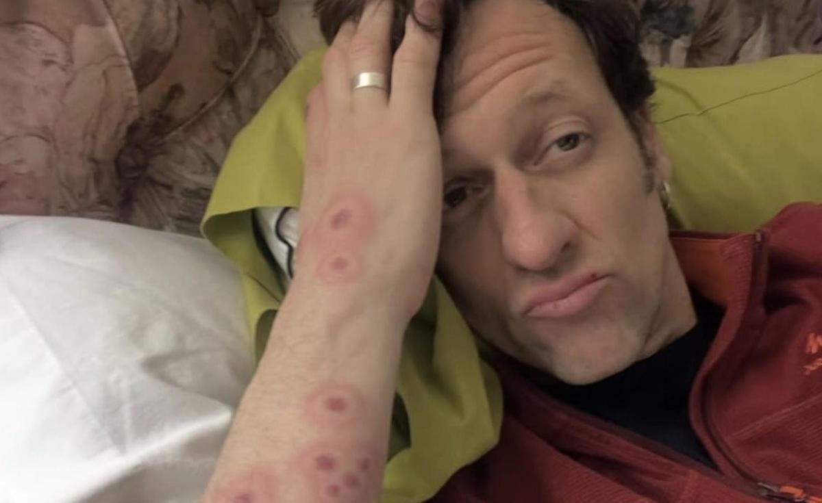 Edu Soto muestra en redes las ronchas provocadas por las picaduras de insectos que le causaron una reacción alérgica.