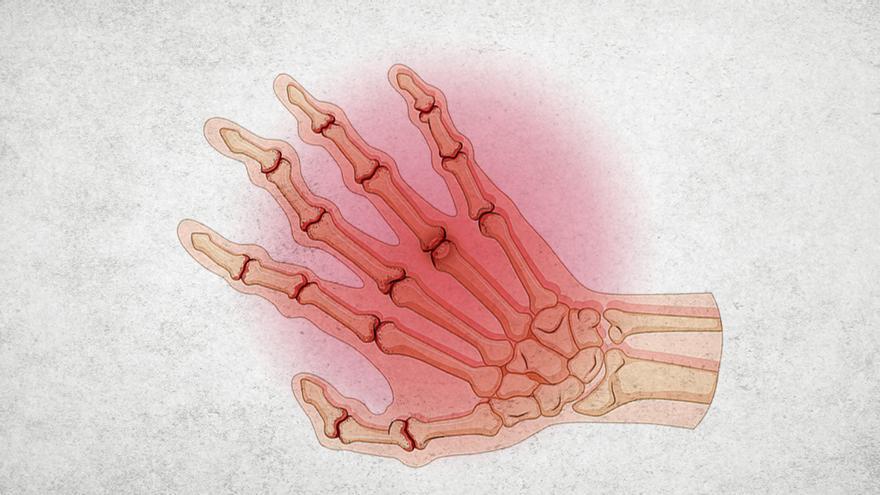 Artritis reumatoide:  la importancia de una intervención precoz para mejorar el futuro de los pacientes