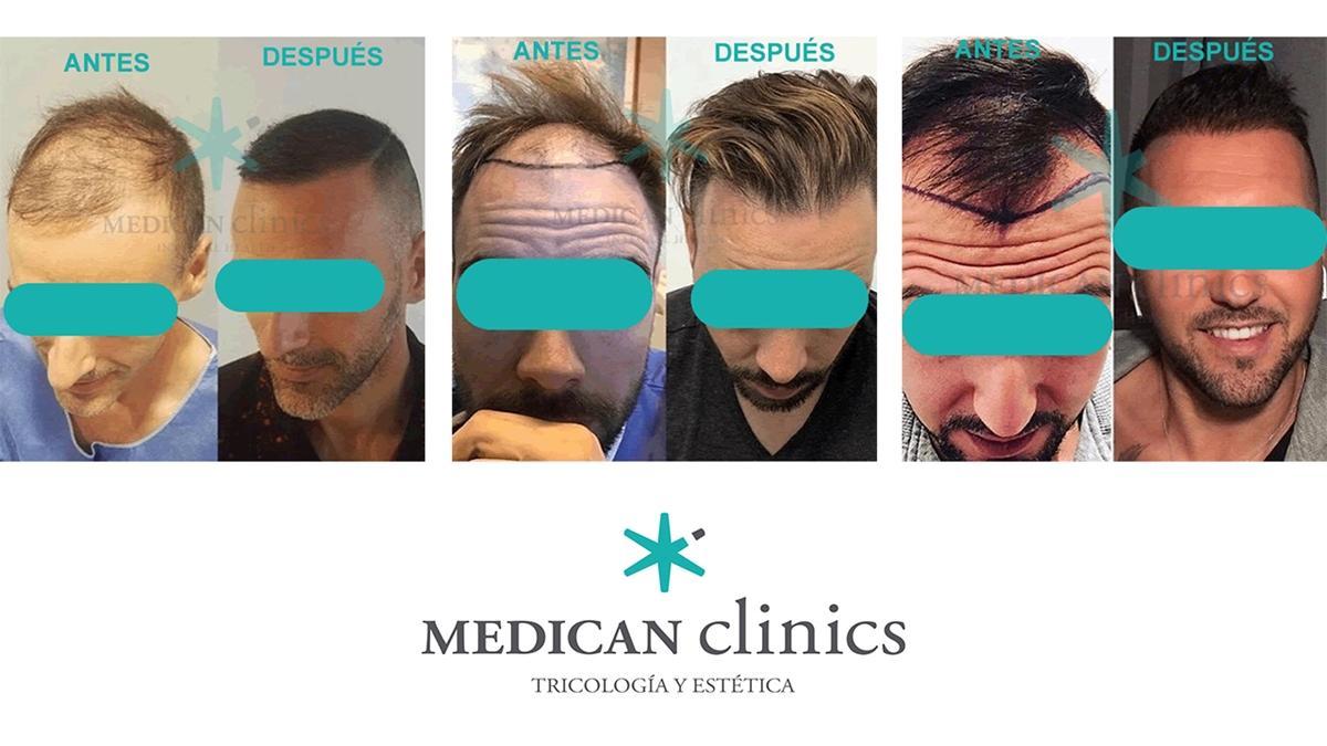 Algunos ejemplos de injerto capilar de Medican Clinics