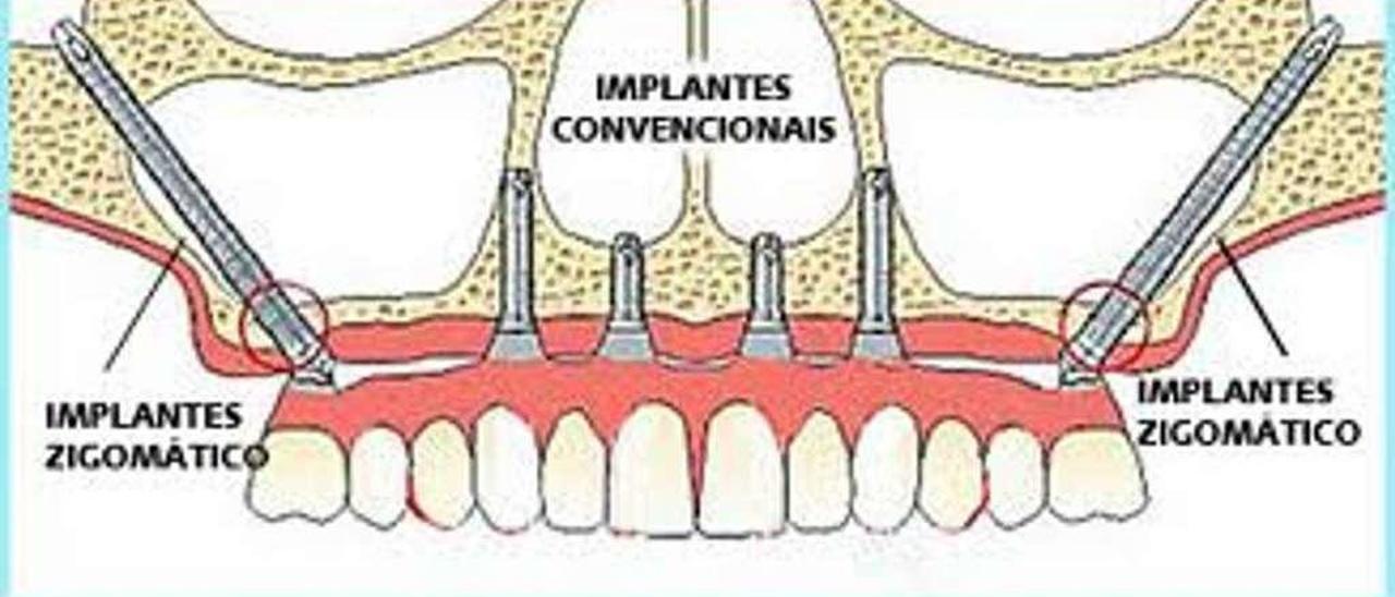 Dentadura superior.