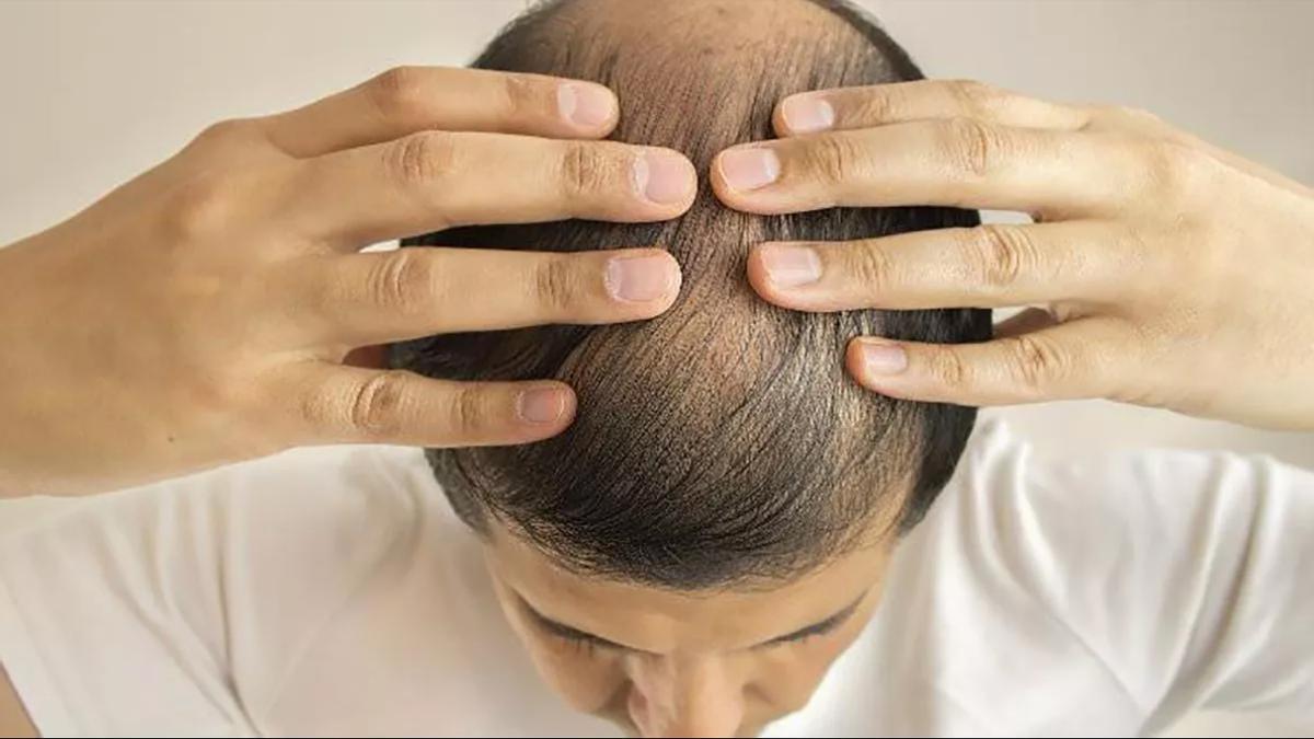 I am a pharmacist and these are the foods I recommend eating to avoid baldness