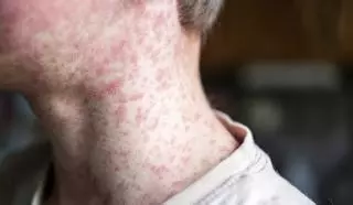 Una sola persona en pot contagiar de xarampió 18 sense vacunar