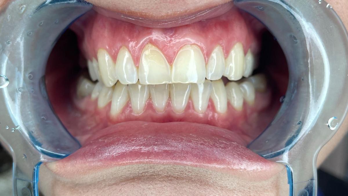 Imagen de una boca en el dentista
