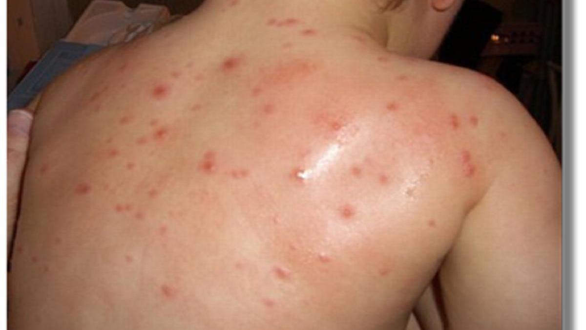 La varicela en la espald ade un niño