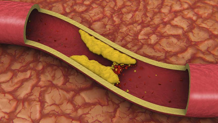 Arteria atascada por colesterol
