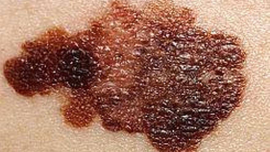 Pugen un 35% els casos de melanoma diagnosticats durant el 2017 a Girona