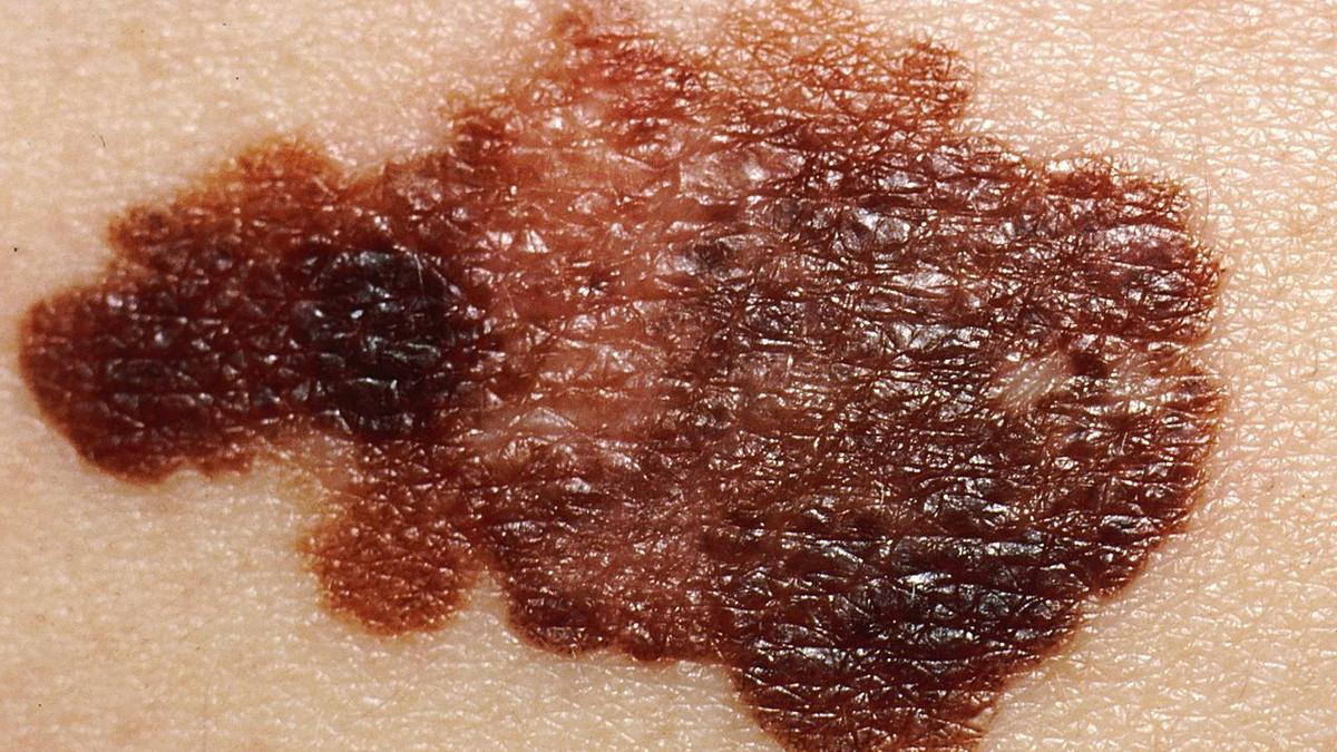 Melanoma en la piel de un paciente