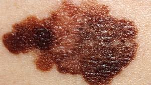 Melanoma en la piel de un paciente
