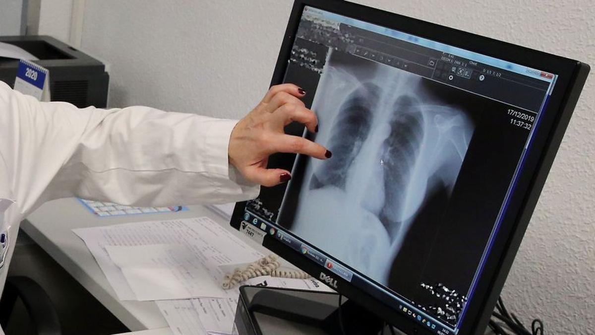 Un estudio español aumenta la esperanza ante el cáncer de pulmón