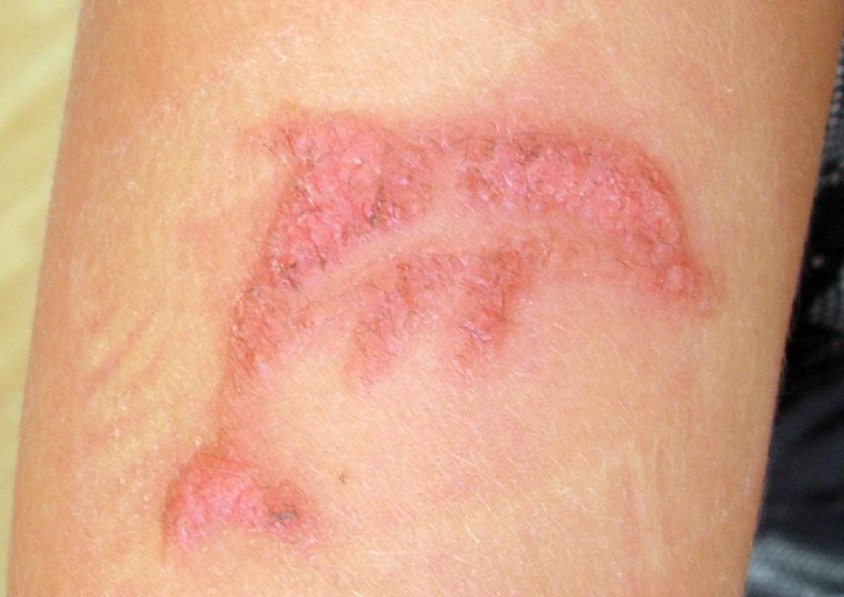 Dermatitis de contacto por tatuaje temporal de henna negra