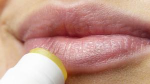 Herpes labial o calenturas, una dolencia frecuente e incómoda