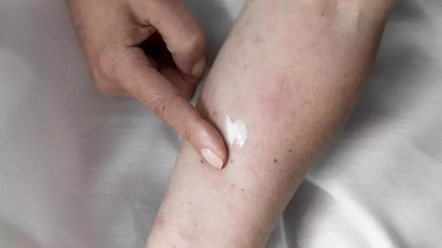 Las cremas y geles que realmente funcionan para aliviar la dermatitis atópica