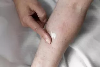 Las cremas y geles que realmente funcionan para aliviar la dermatitis atópica