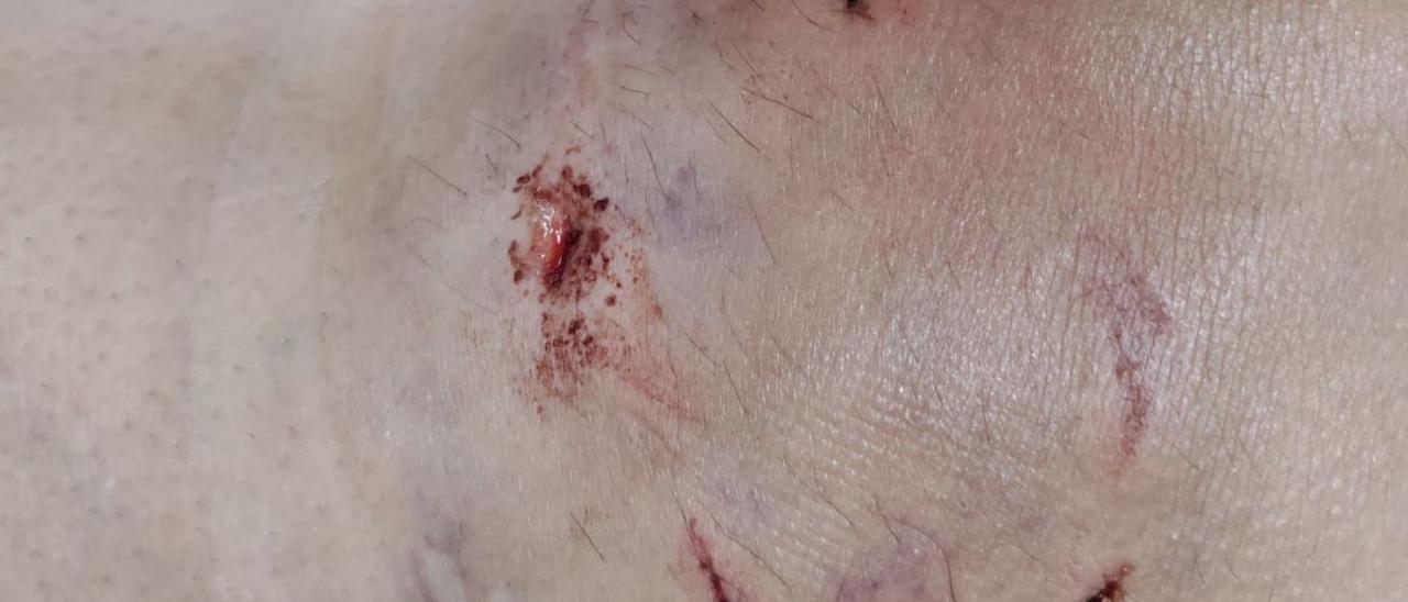 Heridas producidas por los perros en las piernas de la alcaldesa de Riomanzanas. | F. A.