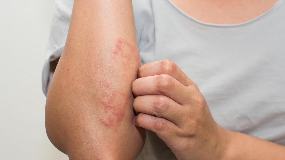 Los principales síntomas de la dermatitis por contacto son la picazón y el enrojecimiento