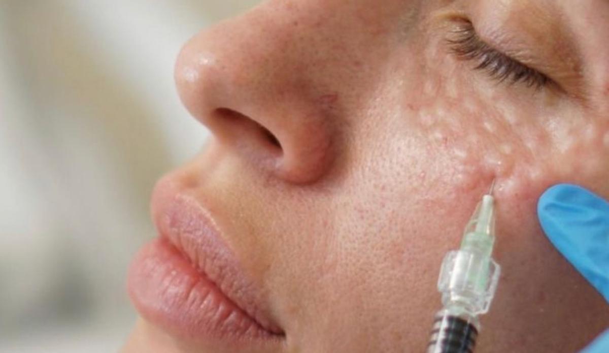 El protocolo que está redefiniendo el rejuvenecimiento facial