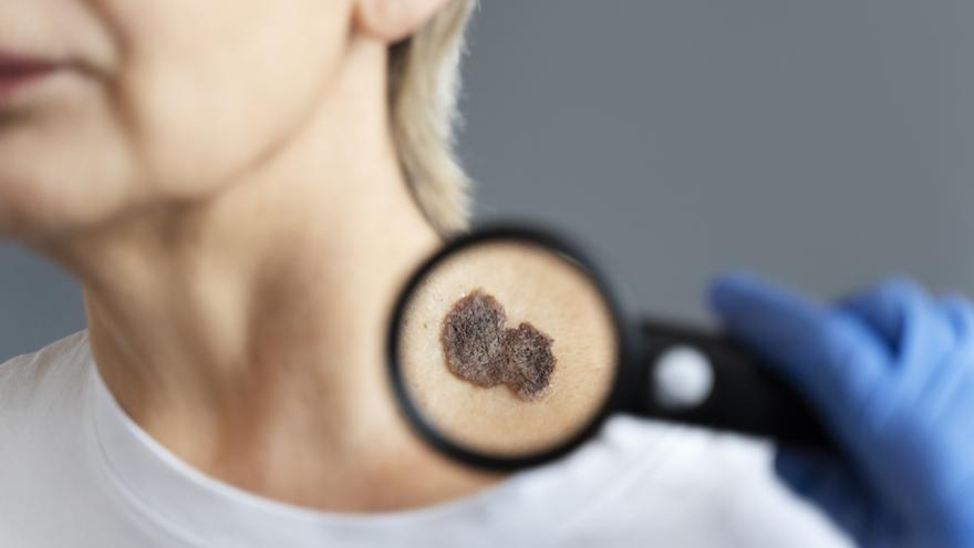 Ocho de cada diez melanomas se pueden curar con diagnóstico precoz