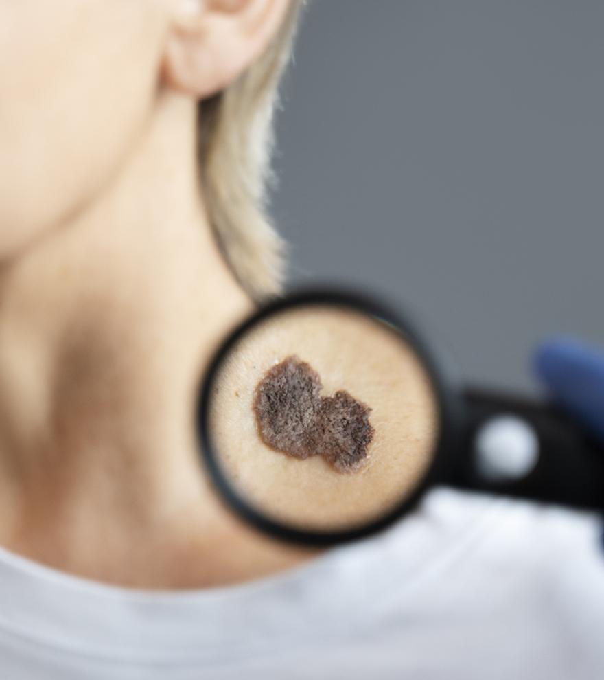 El melanoma no siempre comienza con un lunar en la piel: síntomas y cómo detectarlo a tiempo