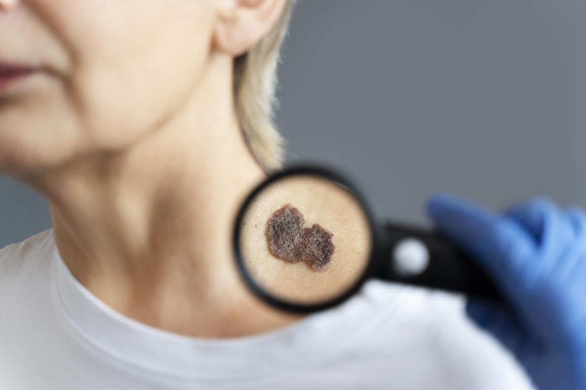 El melanoma no siempre aparece en la piel y a veces no produce síntomas: ¿cómo detectarlo a tiempo?