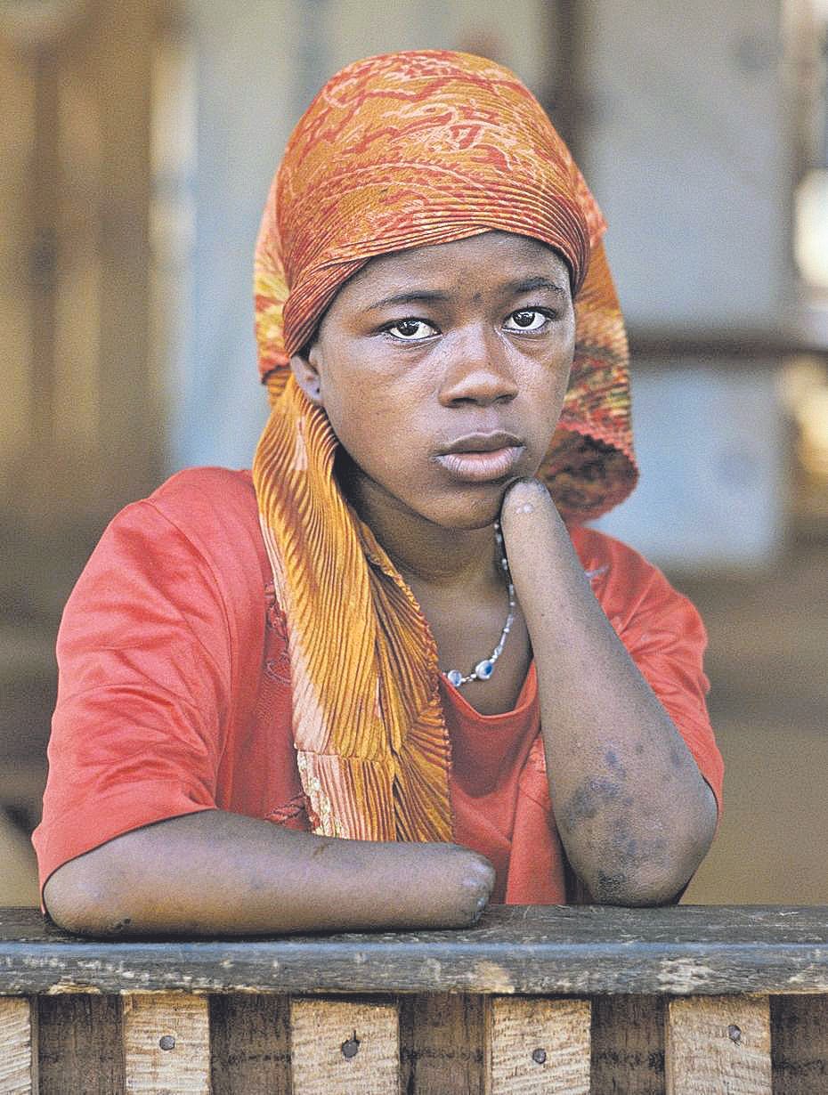 Mariatu Kamara, de 15 años, sufrió la amputación de sus dos manos durante la guerra de Sierra Leona, en 1999.