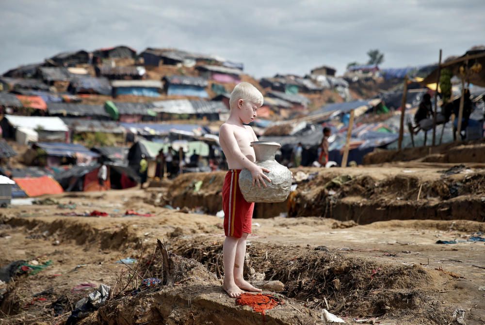 An albino Rohingya refugee poses for a picture ...