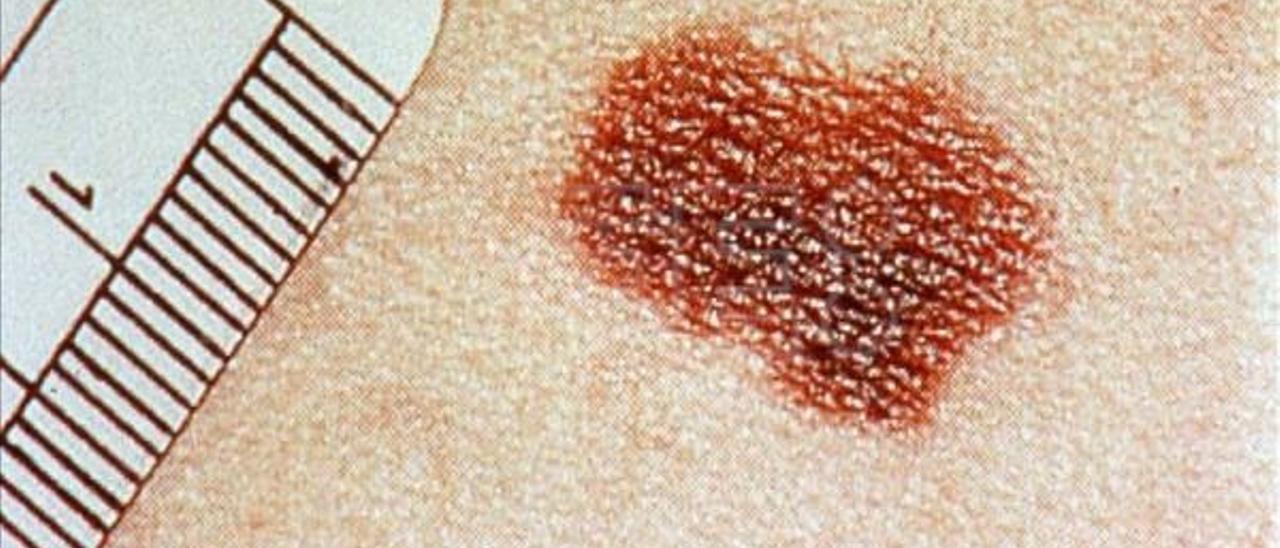 Imagen de un melanoma.