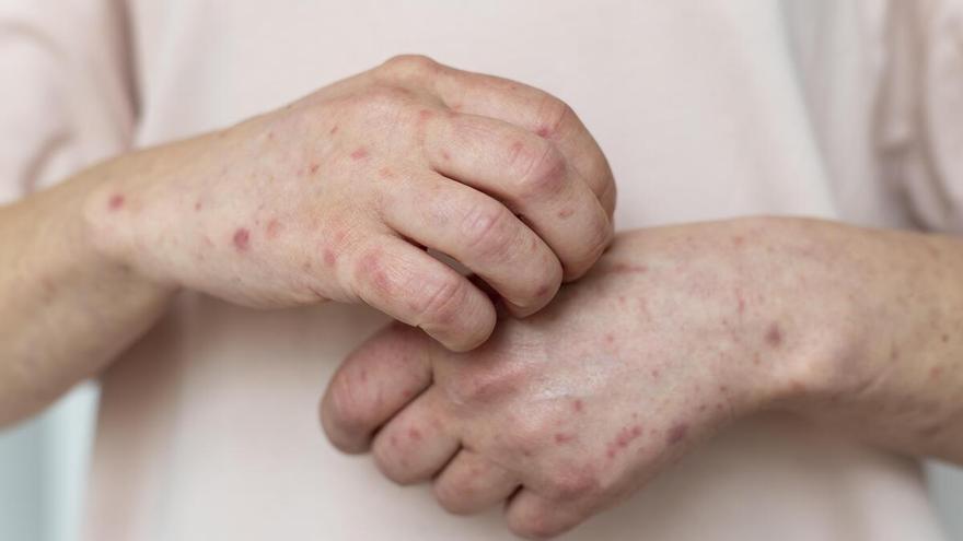 Urticaria crónica espontánea: el desesperante picor que puede afectar a todas las edades