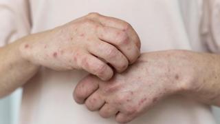 Urticaria crónica espontánea: así es el picor desesperante que afecta a todas las edades