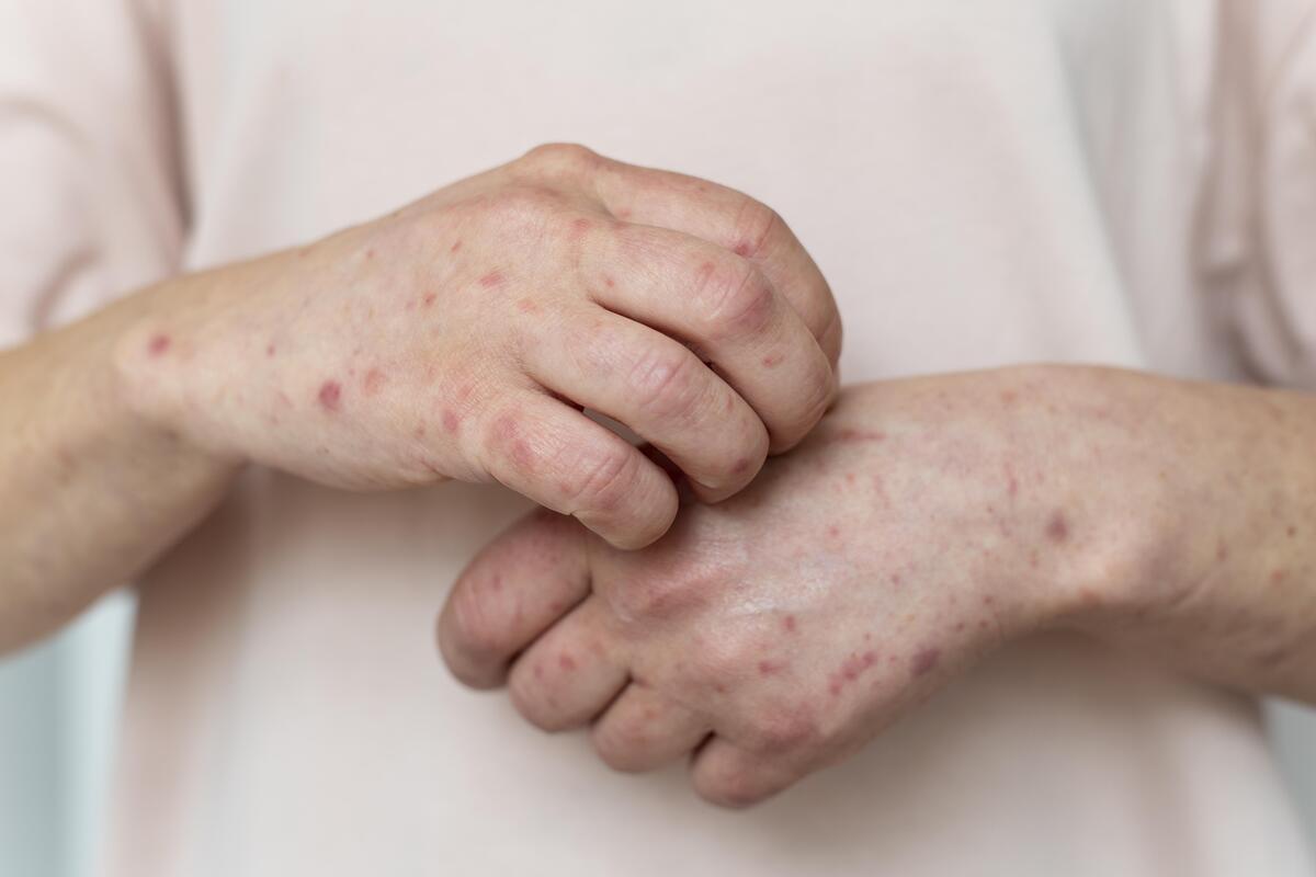 Urticaria crónica espontánea: El desesperante picor que puede afectar a todas las edades Urticaria crónica espontánea: El desesperante picor que puede afectar a todas las edades