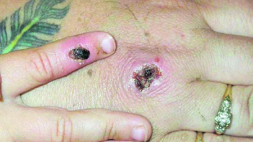 Lesiones cutáneas en una mano provocadas por la viruela del mono. | LEVANTE-EMV