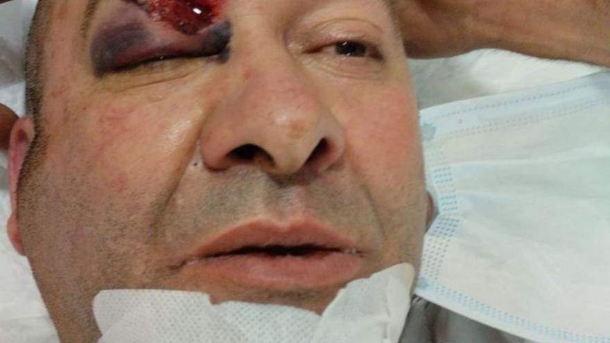 Brutal paliza en Zamora: inconsciente, con una costilla rota y con un párpado rasgado en Castrogonzalo