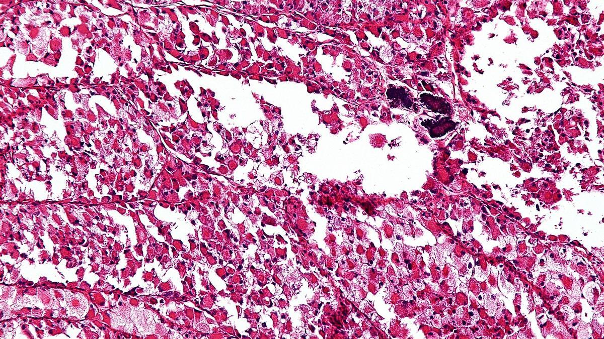 Micrografía ampliada de un sarcoma