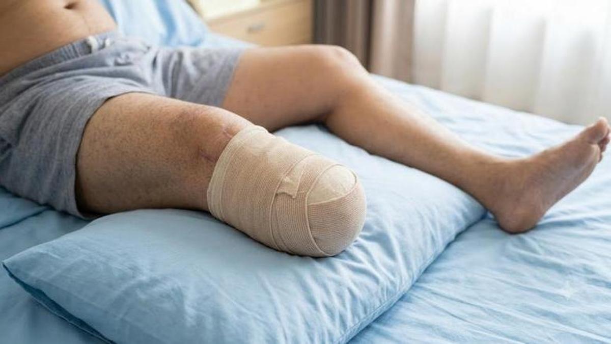 Un hombre con la pierna amputada.