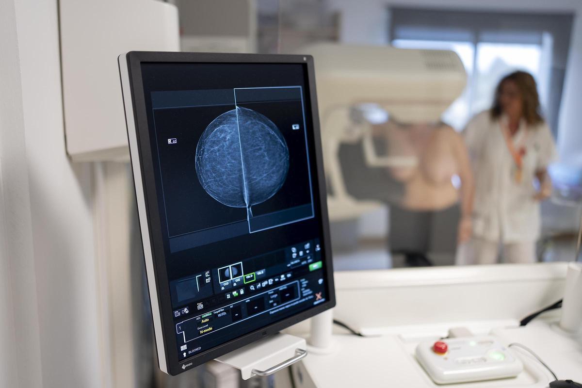En España se diagnosticaron alrededor de 35.312 nuevos cánceres de mama en el año 2023
