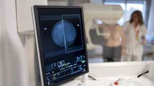 En España se diagnosticaron alrededor de 35.312 nuevos cánceres de mama en el año 2023