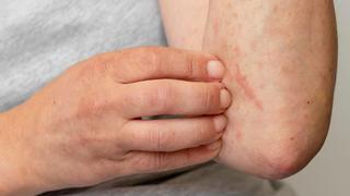 Expertos alertan sobre el aumento de la dermatitis por contacto: causas y cómo evitarla
