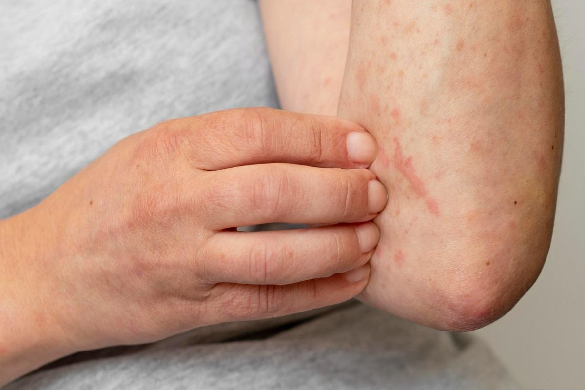 Experts alerten sobre l’augment de la dermatitis per contacte. ¿Quines causes té i com evitar-la?