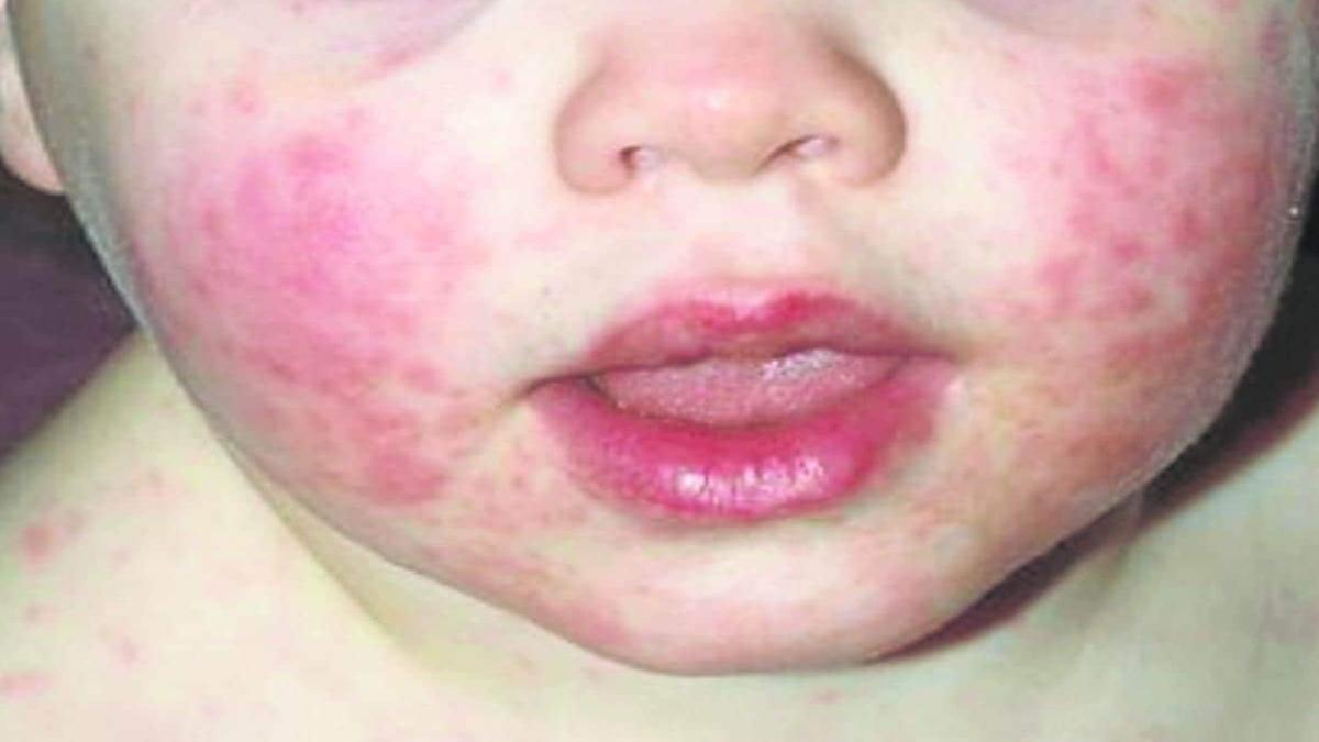 ¿Qués es el virus de la bofetada?