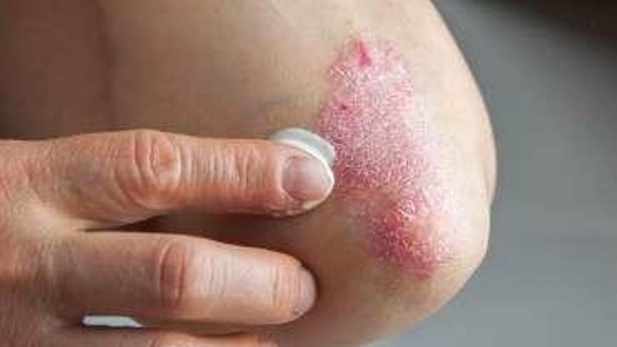 La psoriasis deja huella pronto