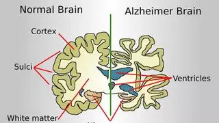 Más de la mitad de las personas que sufren alzhéimer leve están aún sin diagnosticar