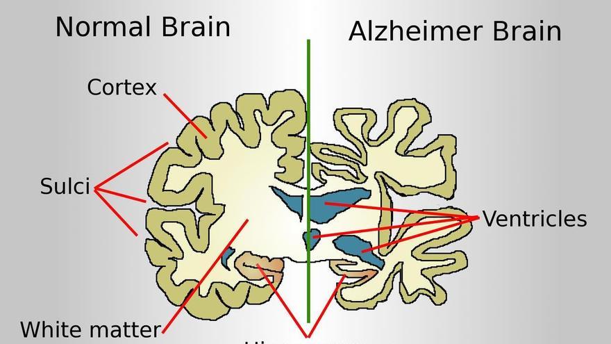 Dibujo comparando el cerebro de un paciente con Alzheimer y un cerebro normal